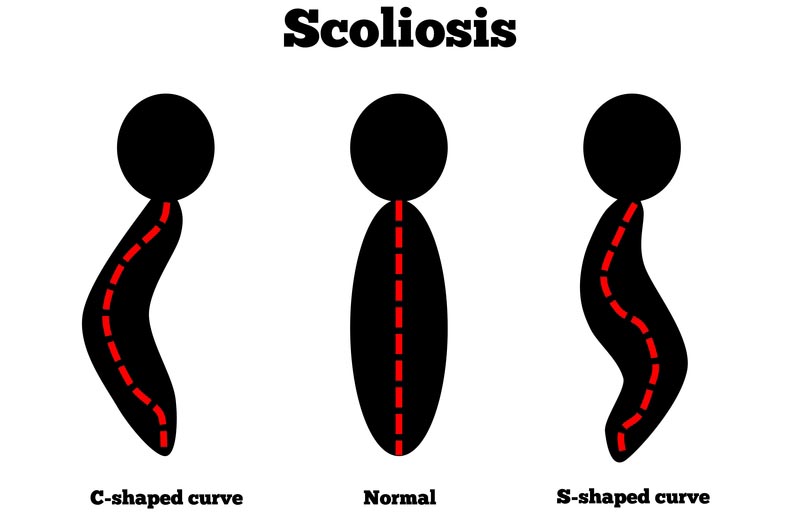 Washington DC,  scoliosis treatment
